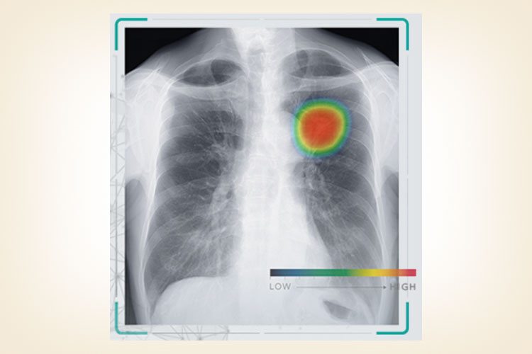 CXR-AID